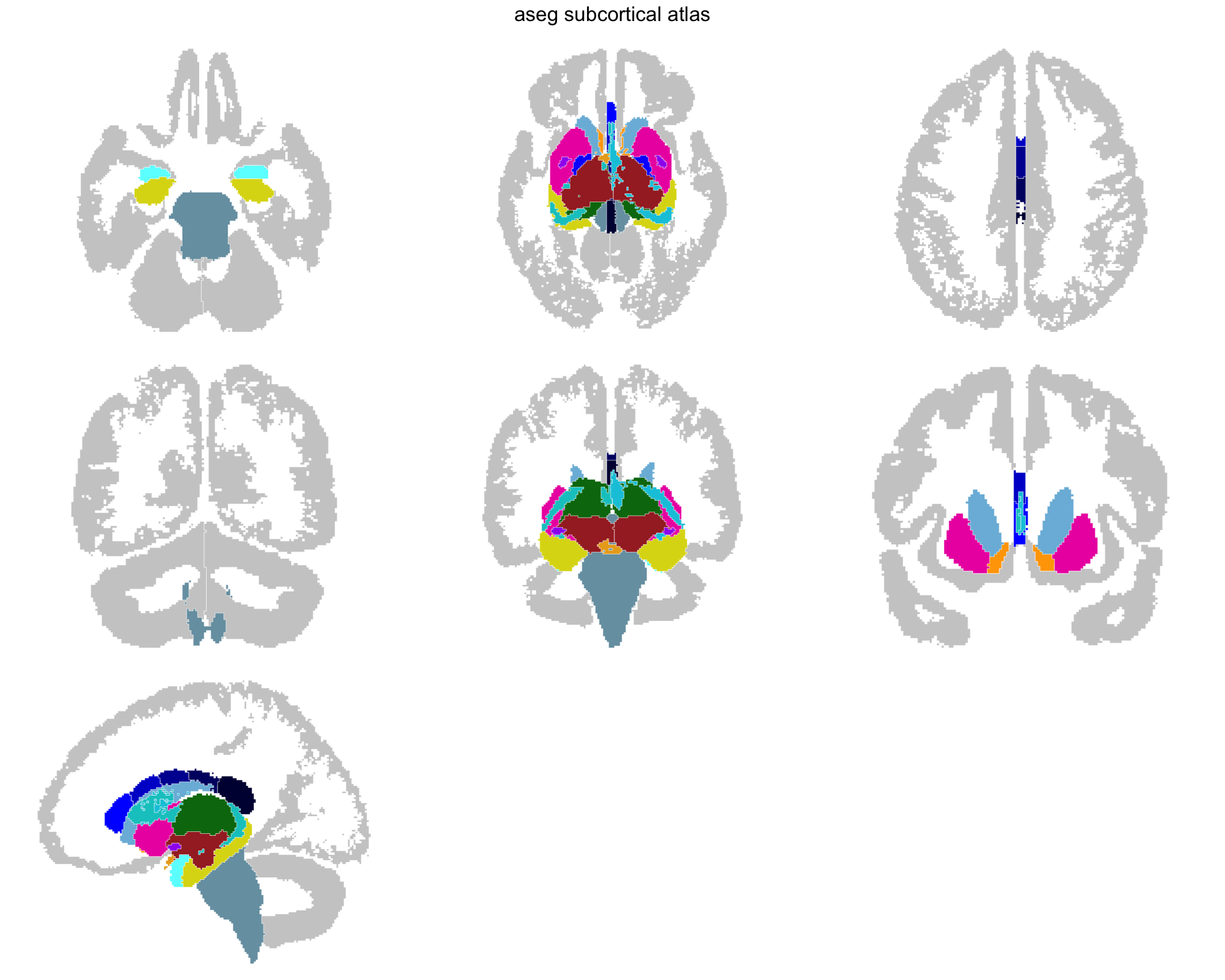 The same views with white matter, ventricles and CSF gone, leaving the deep grey structures on the grey cortex.