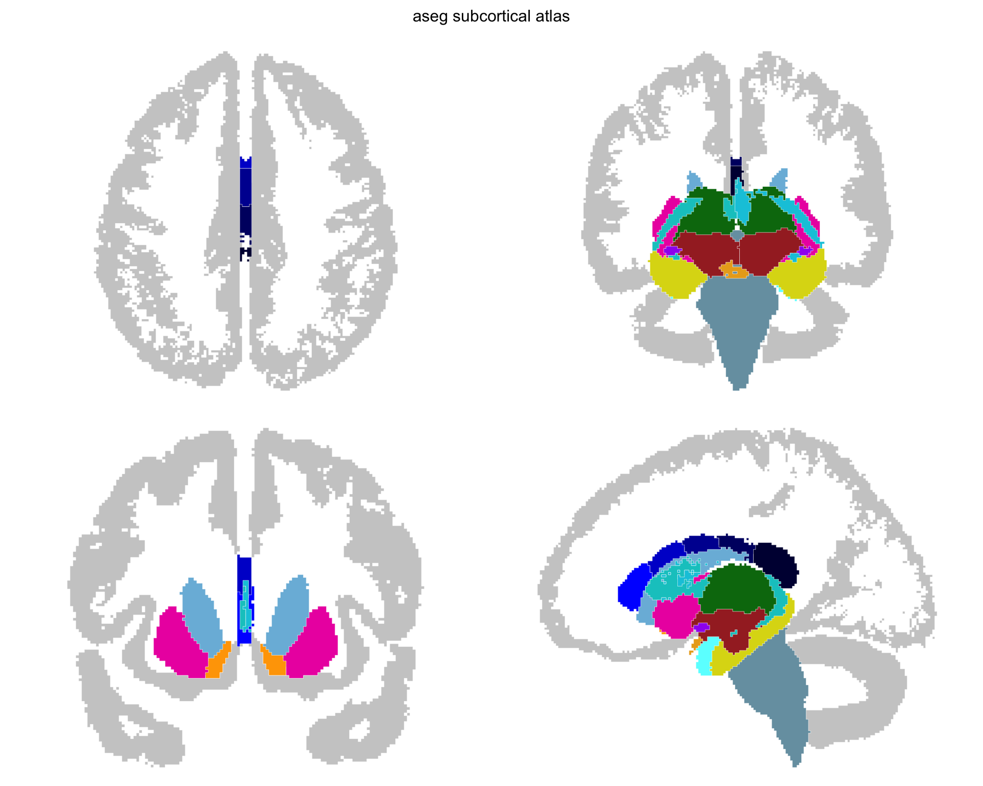 One axial, two coronal and one sagittal view of the deep grey structures, the other three views gone.