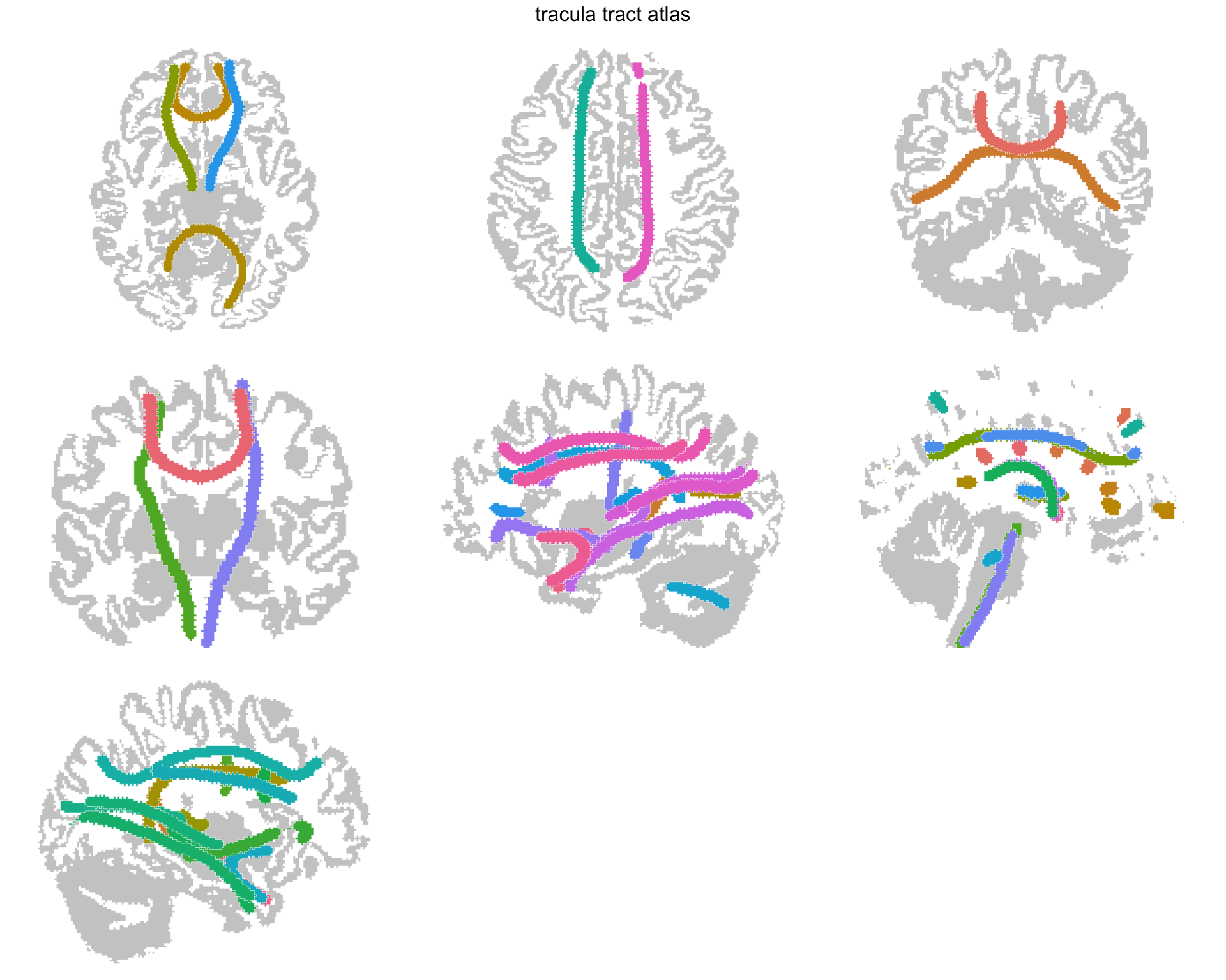 The same views with the small cross-sectional fragments removed, leaving the coherent tract bodies.