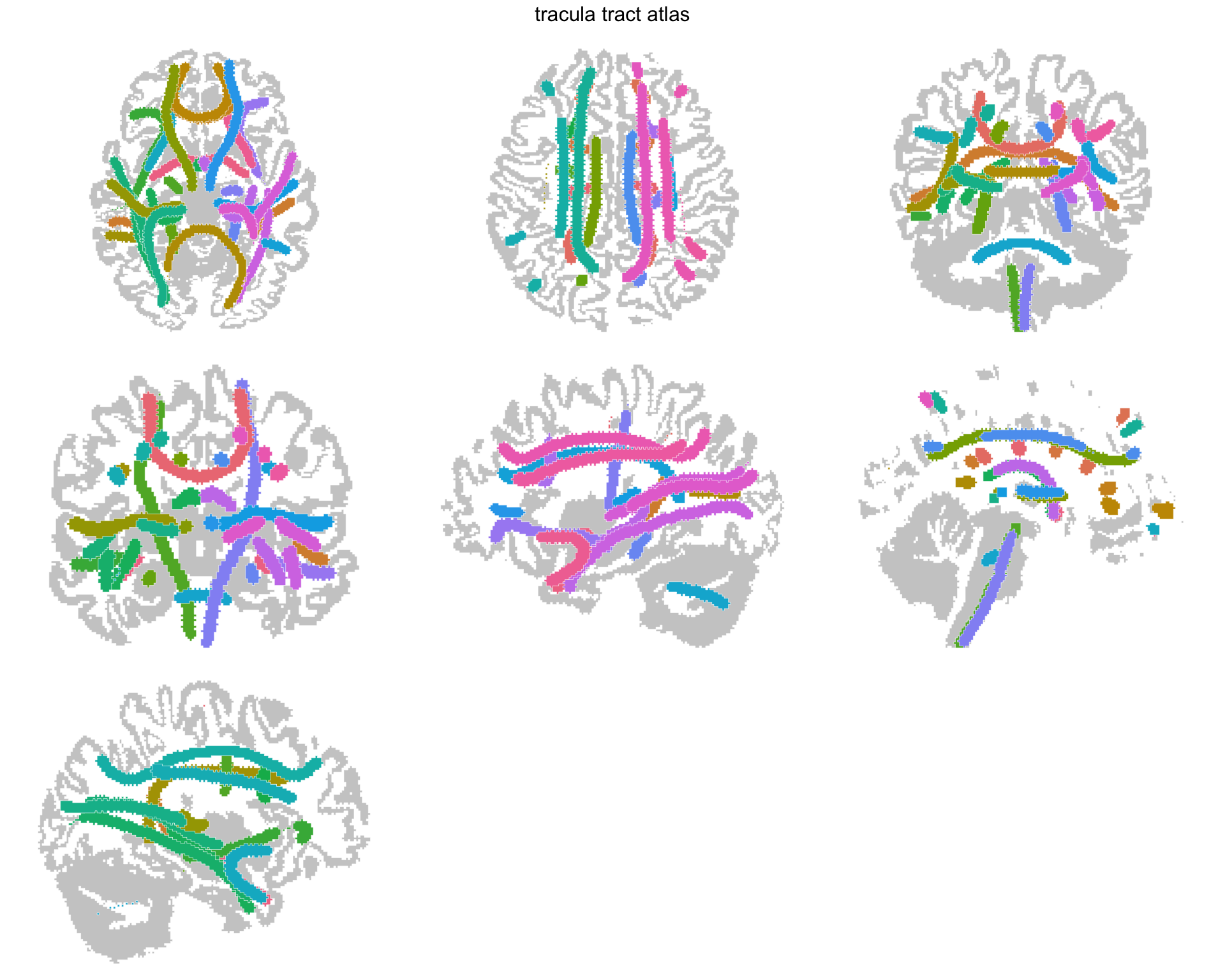 The tracts on the seven retained projection views, two axial, two coronal and three sagittal.